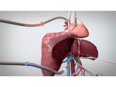 Hepatectomy