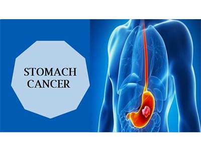 Stomach Cancer Surgery