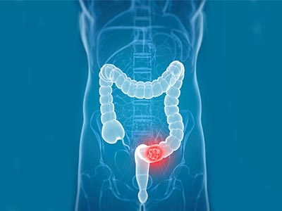 Colon Cancer Surgery