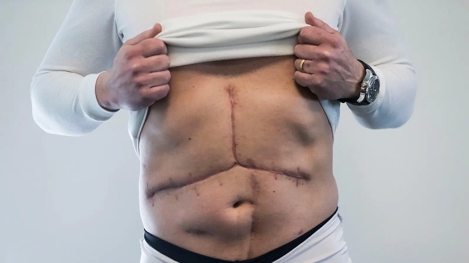 Post Liver Transplant